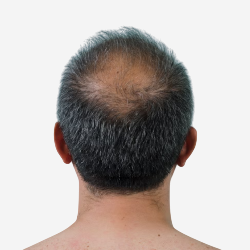 Hair Loss