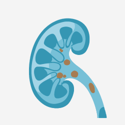 Kidney Stones