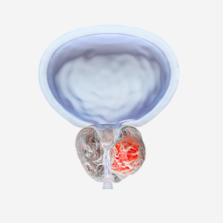 Prostate Cancer